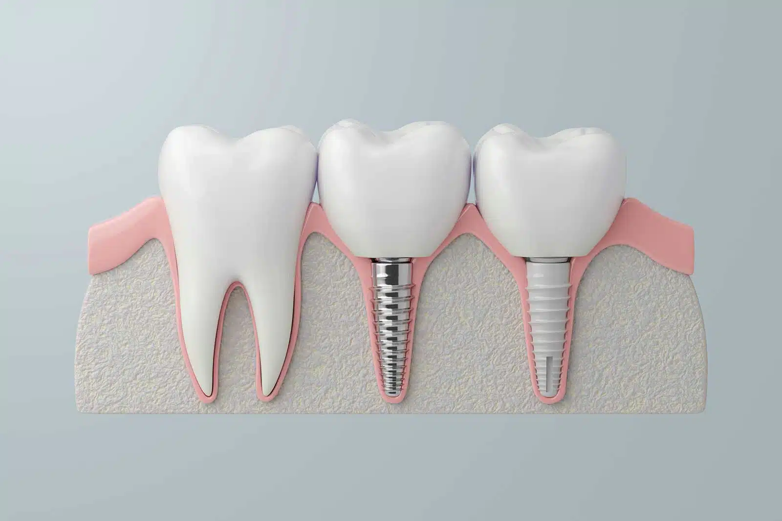 mejor-tipo-de-implantes-dentales